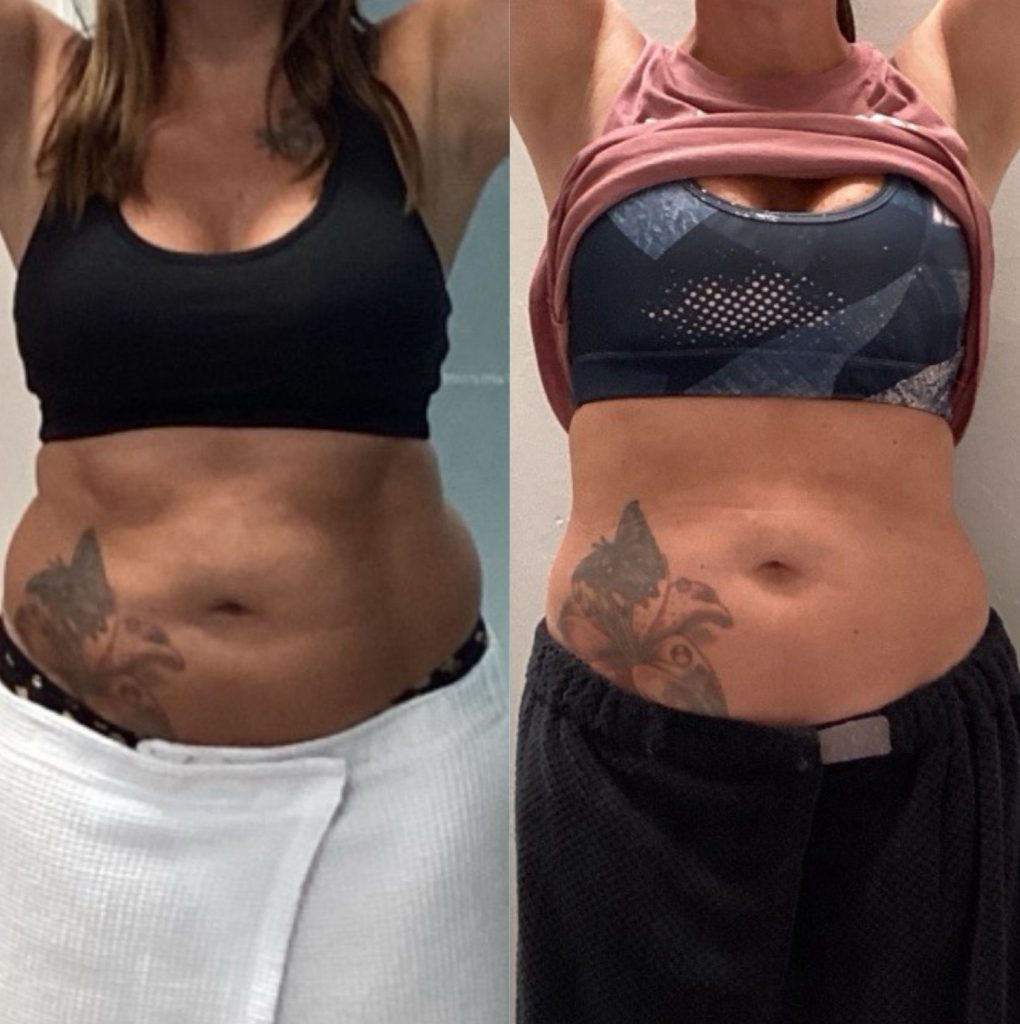 Artemis T-Shape 2 Before & After Patient #3964