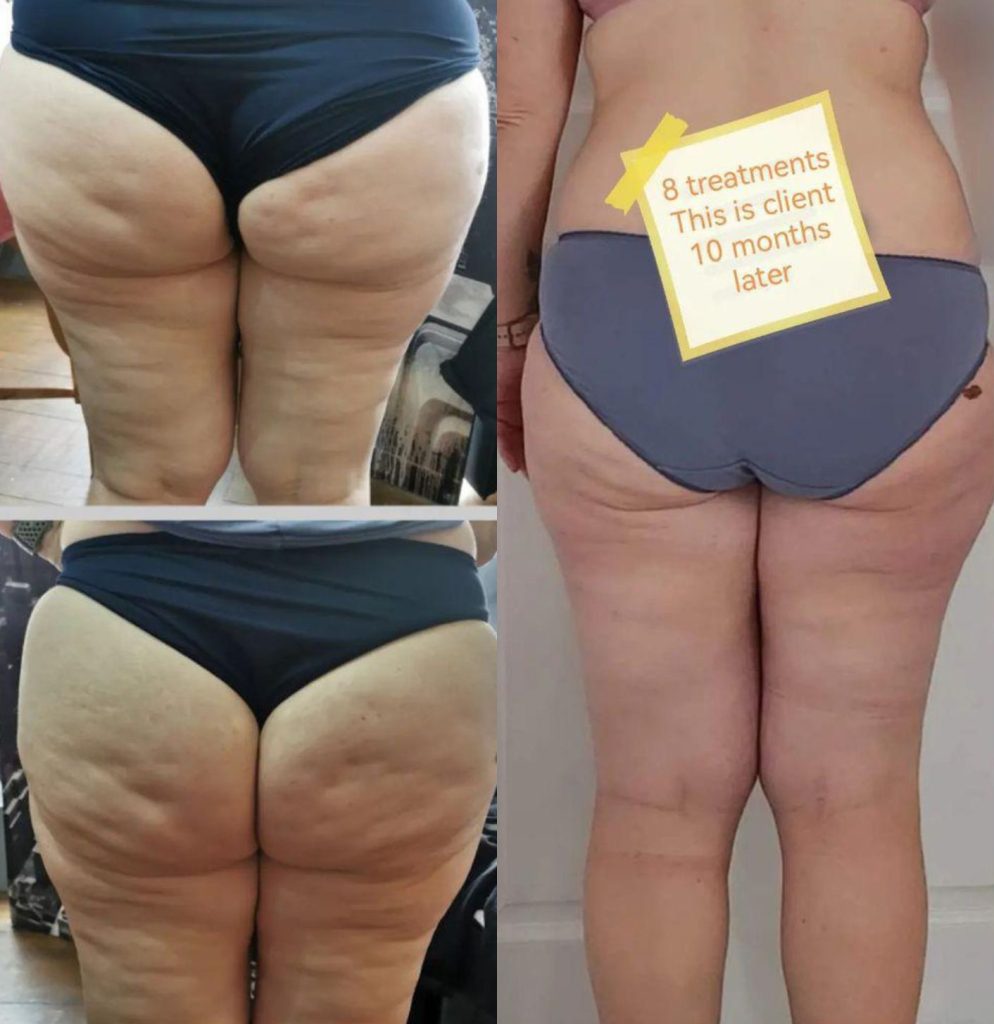 Artemis T-Shape 2 Before & After Patient #3965