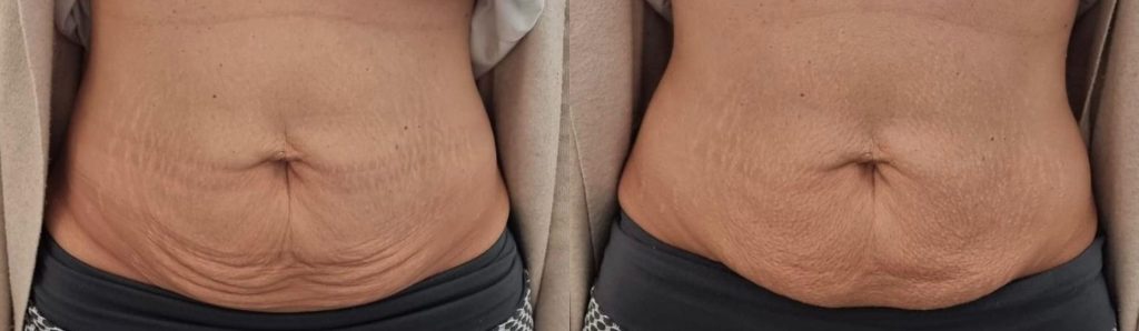 Artemis T-Shape 2 Before & After Patient #3967
