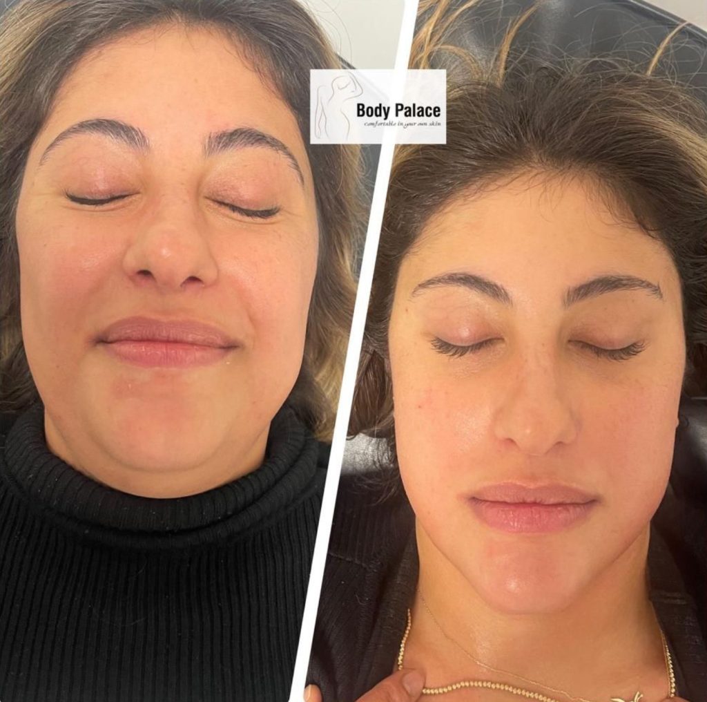 Artemis T-Shape 2 Before & After Patient #3969