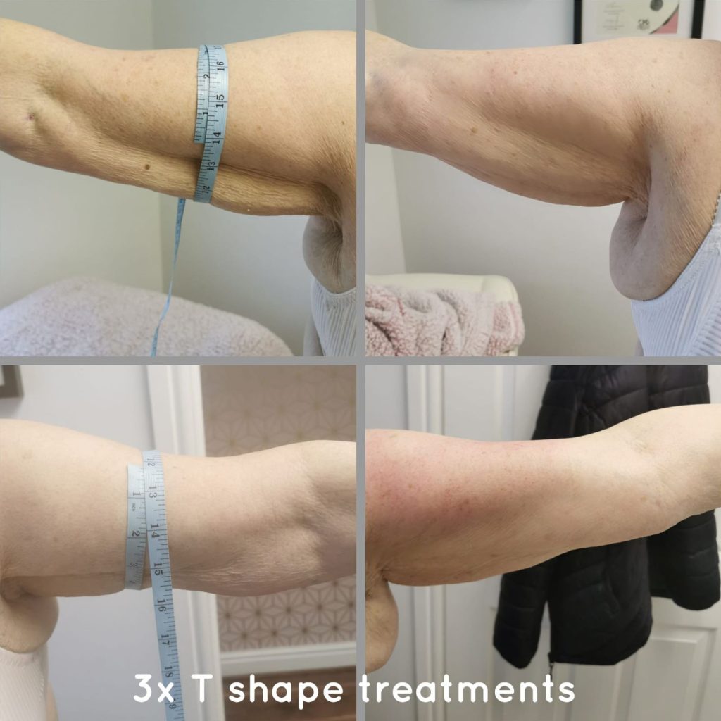 Artemis T-Shape 2 Before & After Patient #3943