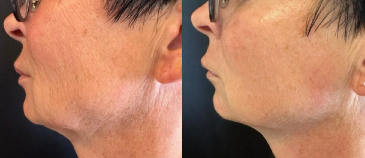 Artemis T-Shape 2 Before & After Patient #3916