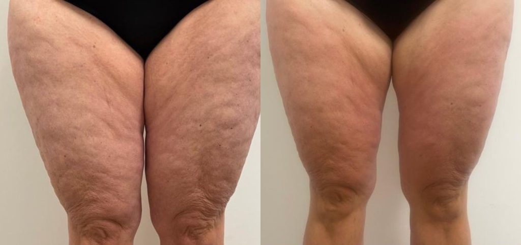 Artemis T-Shape 2 Before & After Patient #3970
