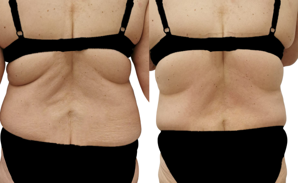 Artemis T-Shape 2 Before & After Patient #3917