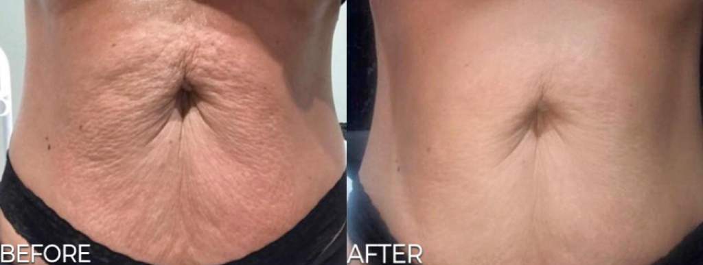 Artemis T-Shape 2 Before & After Patient #3918