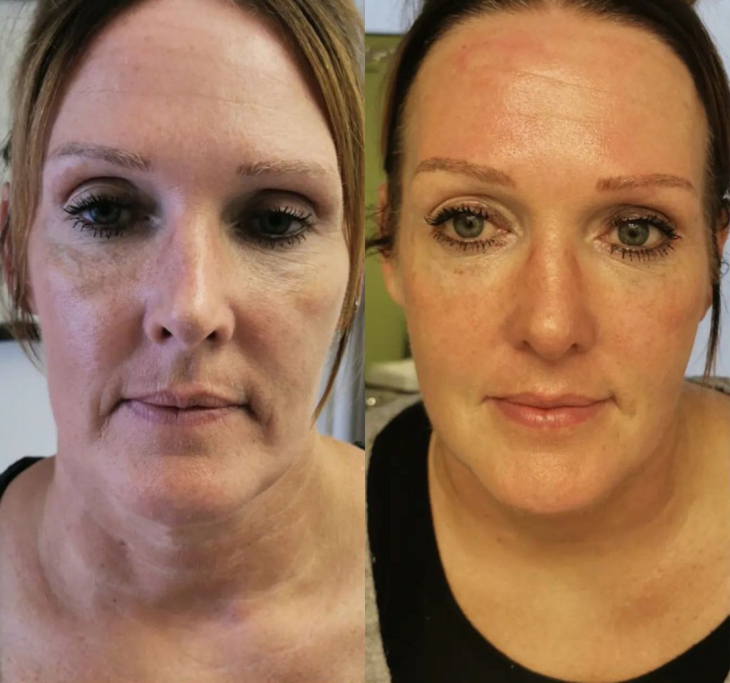 Artemis T-Shape 2 Before & After Patient #3947