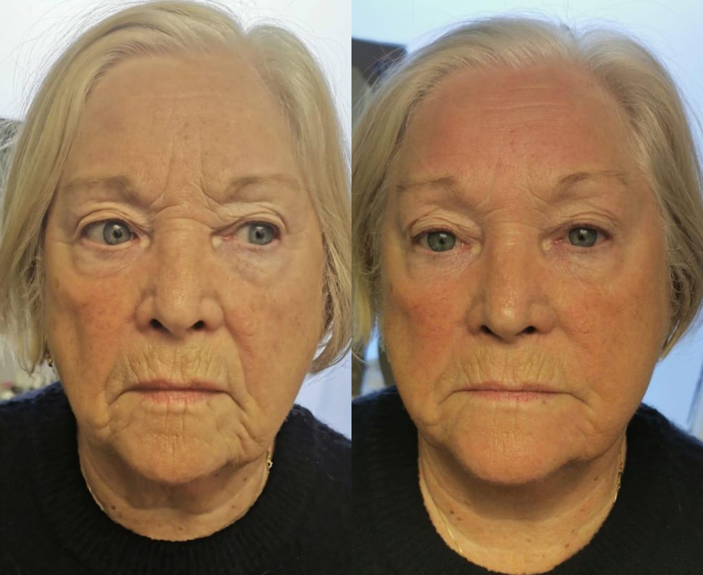 Artemis T-Shape 2 Before & After Patient #3948