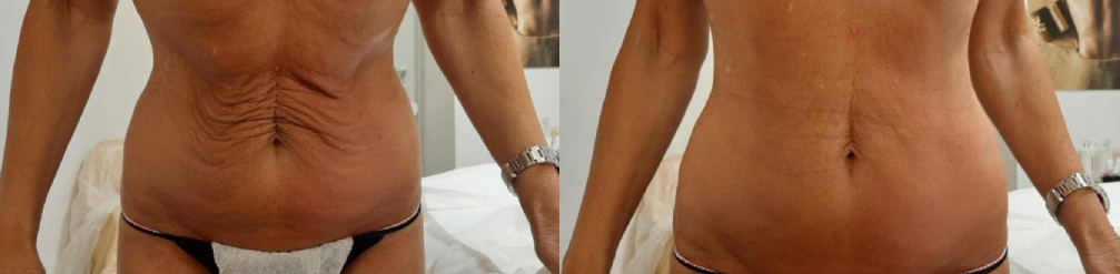 Artemis T-Shape 2 Before & After Patient #3919