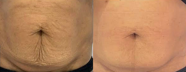 Artemis T-Shape 2 Before & After Patient #3950