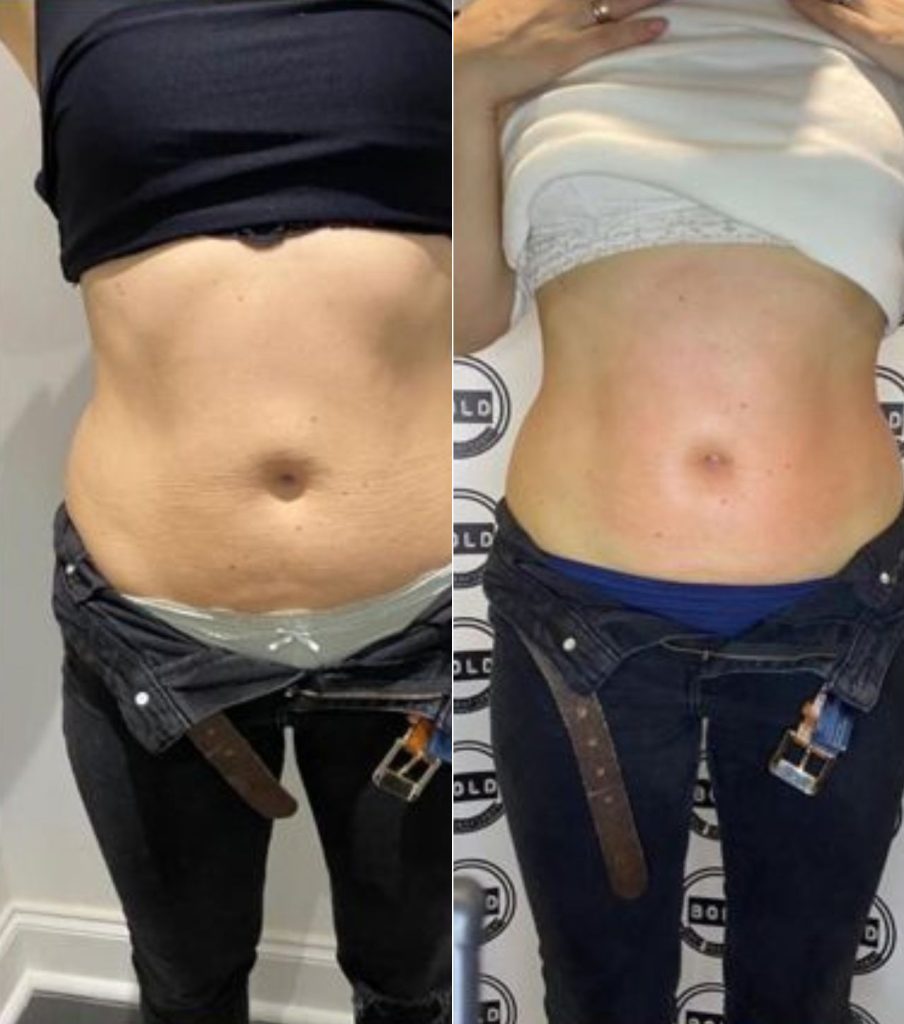Artemis T-Shape 2 Before & After Patient #3954