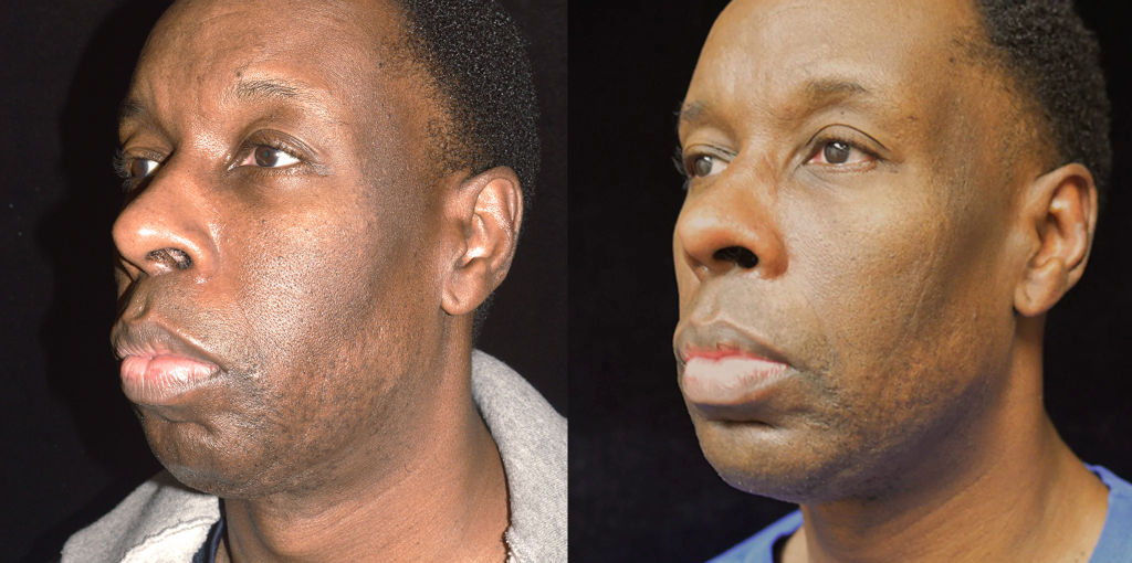 Chin Augmentation/Implant Before & After Patient #4156