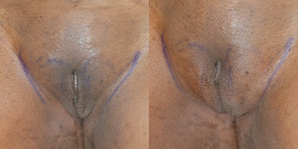 Labiaplasty Before & After Patient #4180
