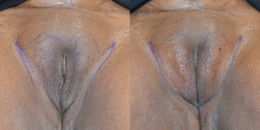 Labiaplasty Before & After Patient #4180