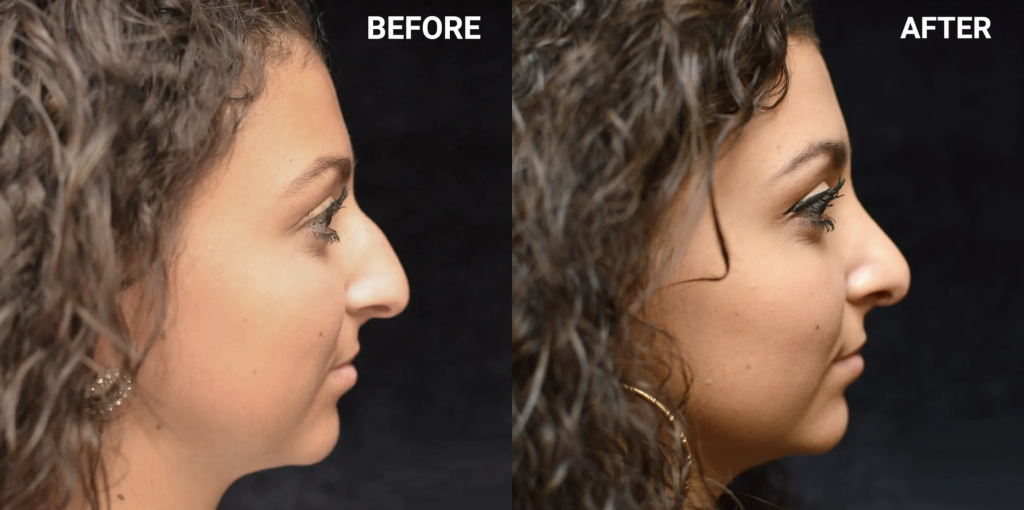 Rhinoplasty Before & After Patient #4155