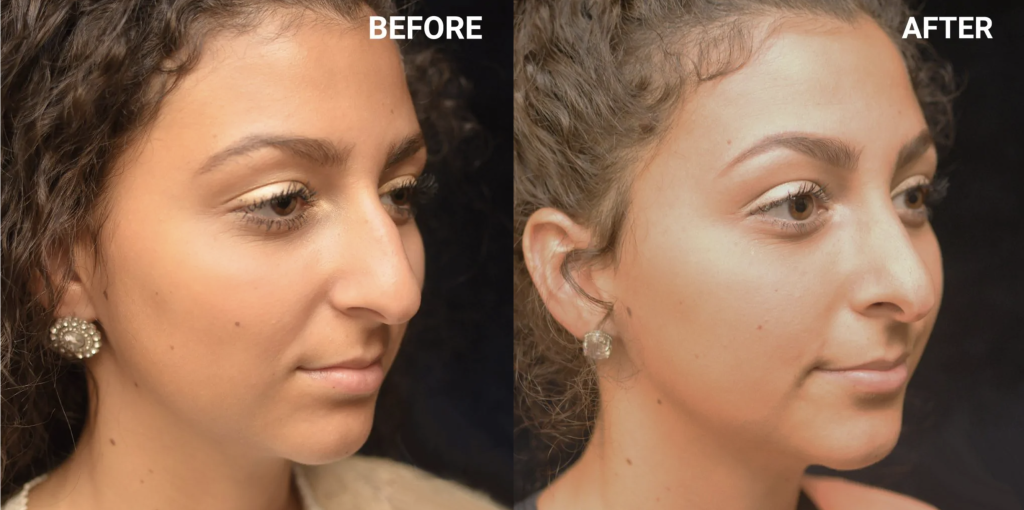 Rhinoplasty Before & After Patient #4155