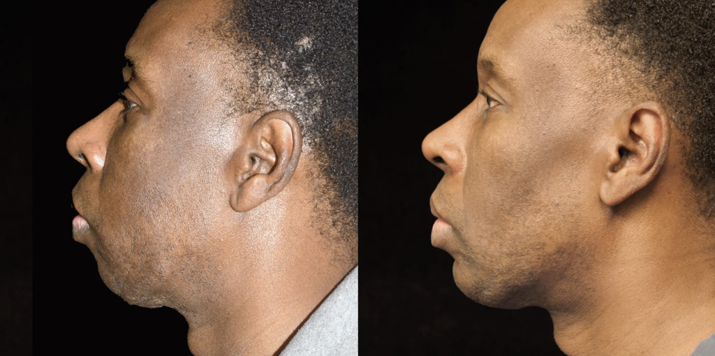 Chin Augmentation/Implant Before & After Patient #4156