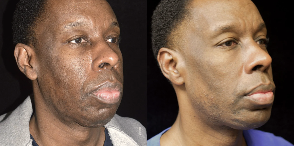 Chin Augmentation/Implant Before & After Patient #4156
