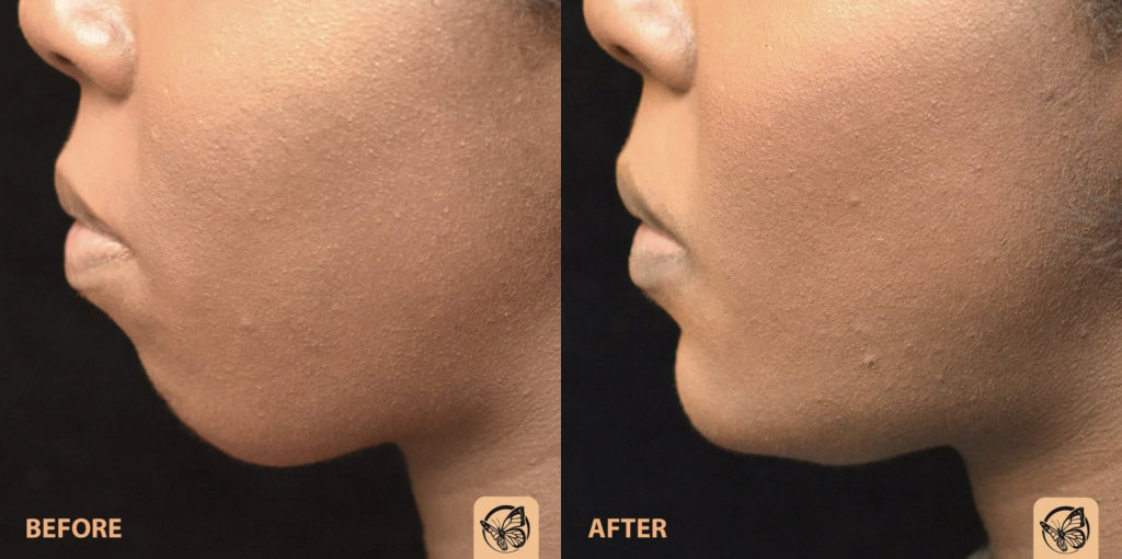 Chin Augmentation/Implant Before & After Patient #4157