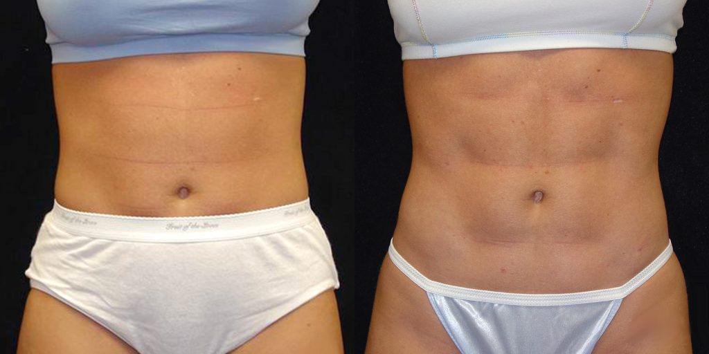 Ab Etching/6 Pack Abs Before & After Patient #4202