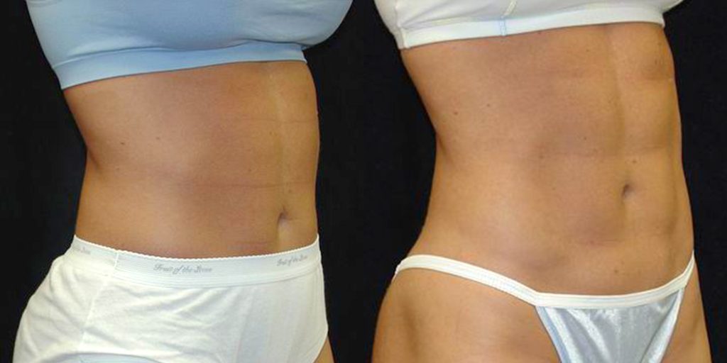 Ab Etching/6 Pack Abs Before & After Patient #4202