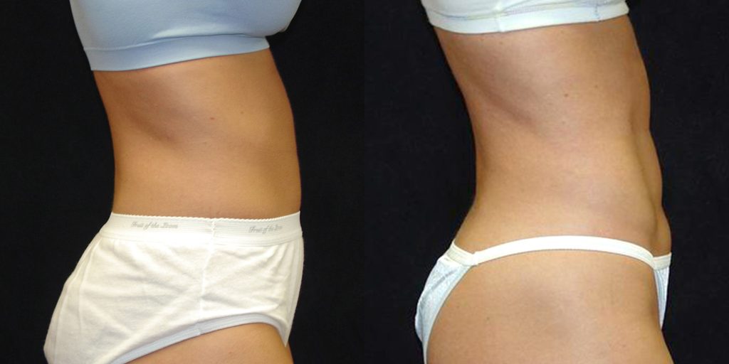 Ab Etching/6 Pack Abs Before & After Patient #4202
