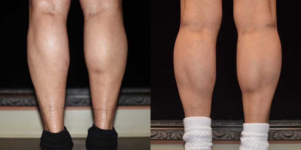 Calf Implants Before & After Patient #4212