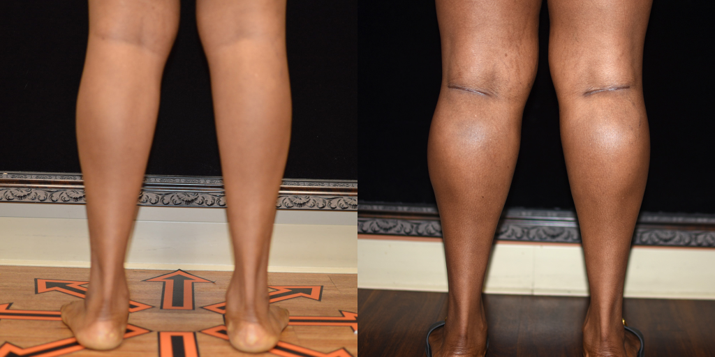 Calf Implants Before & After Patient #4214
