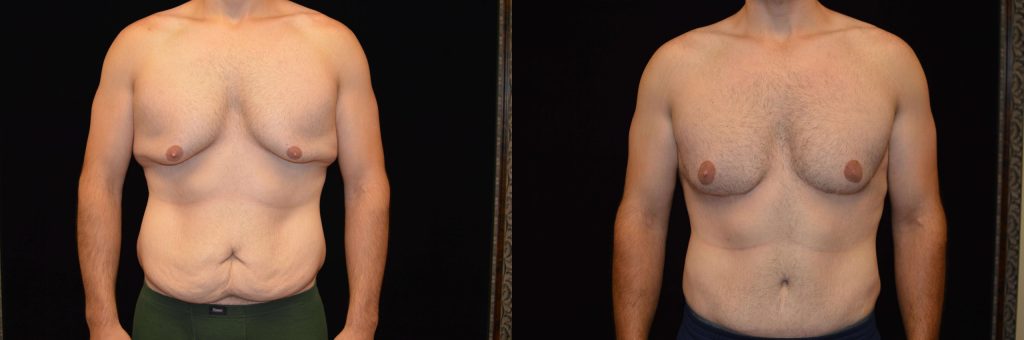 Upper Body Lift Before & After Patient #4304