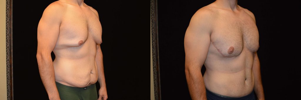 Upper Body Lift Before & After Patient #4304