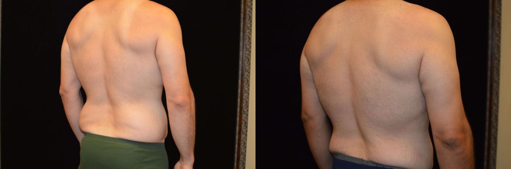 Upper Body Lift Before & After Patient #4304