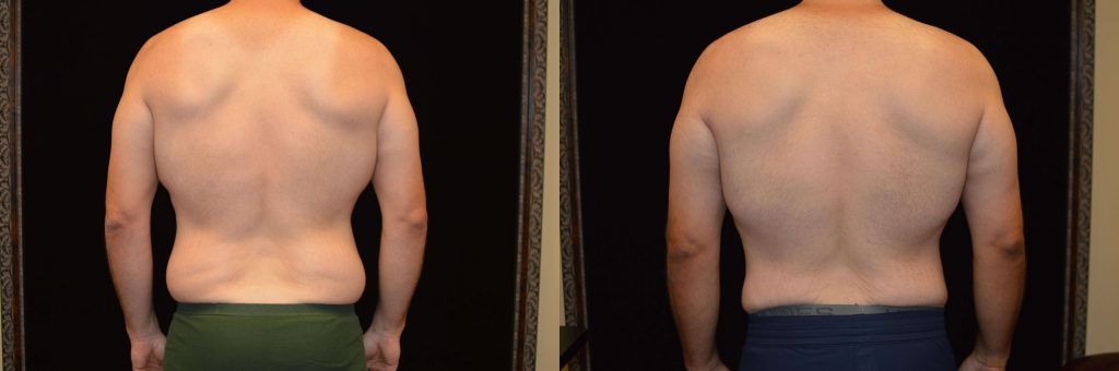 Upper Body Lift Before & After Patient #4304