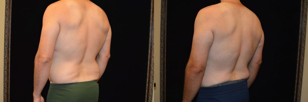 Upper Body Lift Before & After Patient #4304