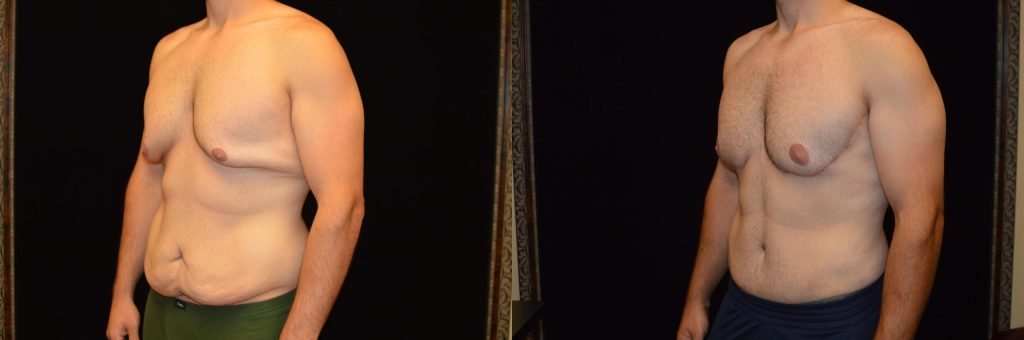 Upper Body Lift Before & After Patient #4304