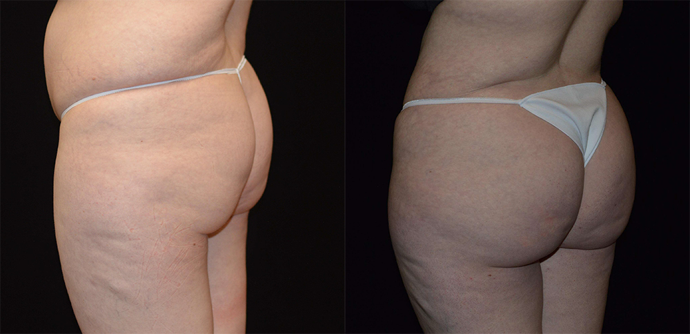 Brazilian Butt Lift Before & After Patient #4303
