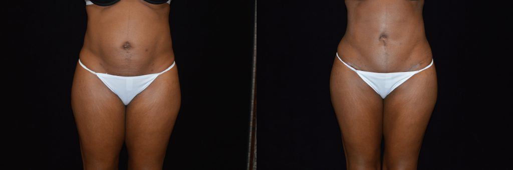Tummy Tuck Before & After Patient #4290