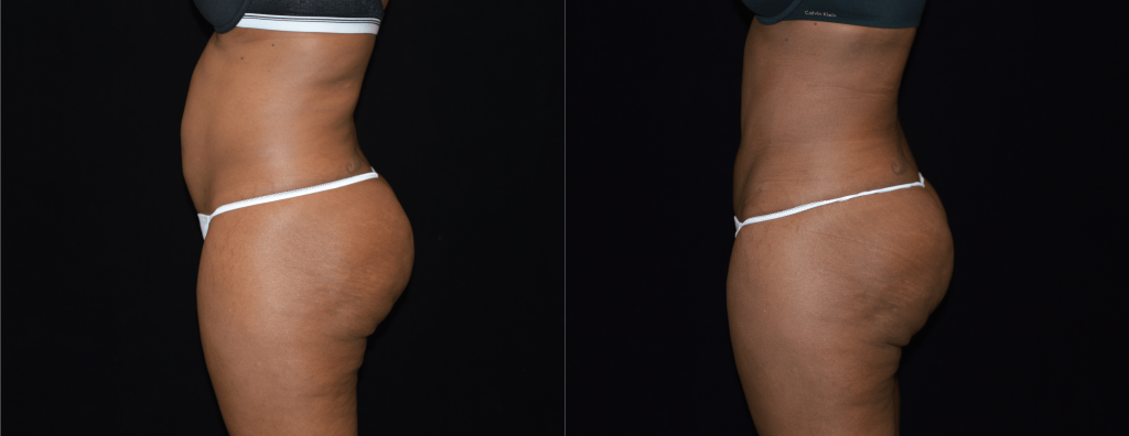 Tummy Tuck Before & After Patient #4290