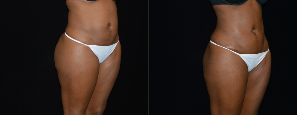 Tummy Tuck Before & After Patient #4290