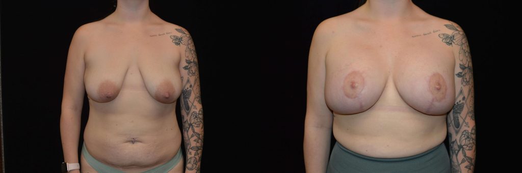 Breast Lift with Implants Before & After Patient #4305