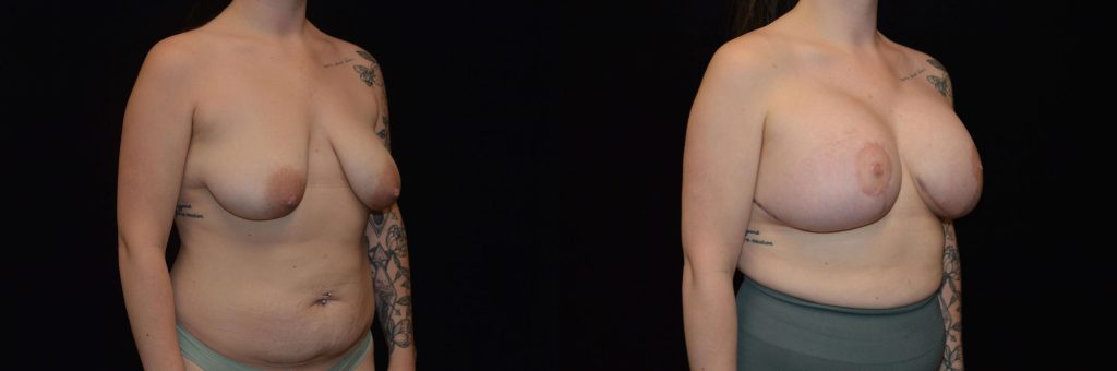 Breast Lift with Implants Before & After Patient #4305