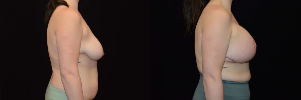 Breast Lift with Implants Before & After Patient #4305