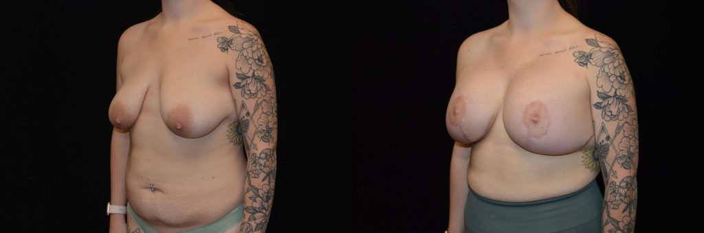 Breast Lift with Implants Before & After Patient #4305