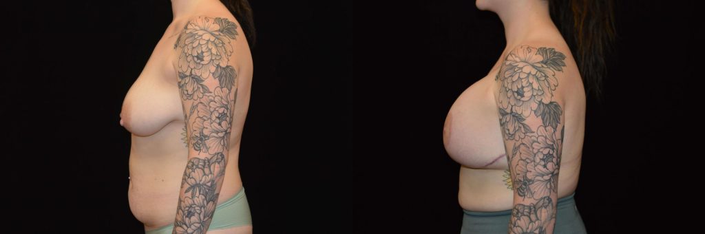 Breast Lift with Implants Before & After Patient #4305