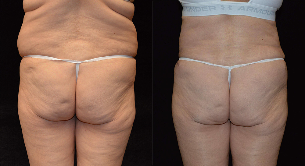Brazilian Butt Lift Before & After Patient #4302