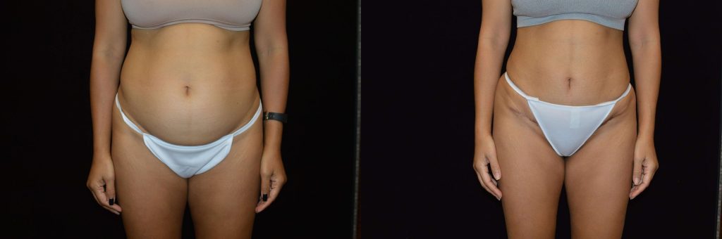 Tummy Tuck Before & After Patient #4306