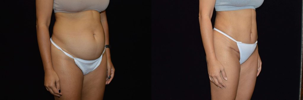 Tummy Tuck Before & After Patient #4306